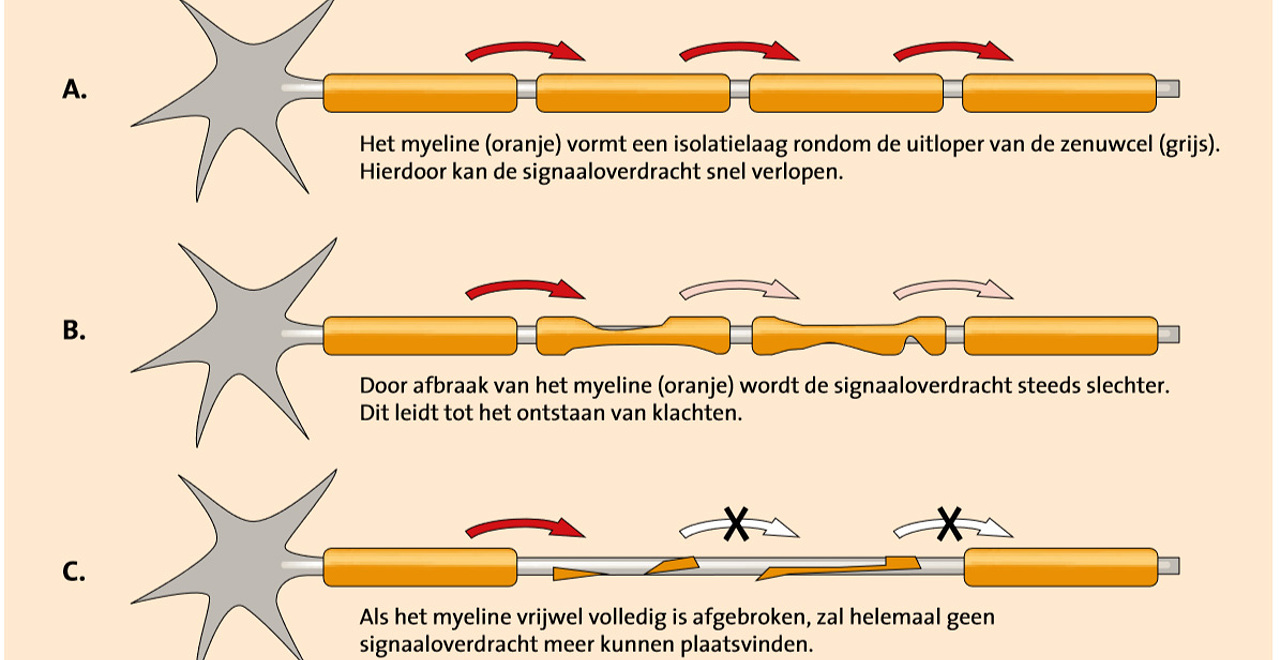 Aantasting Van De Zenuwen (perifere Neuropathie) Tot Zenuwuitval Door ...